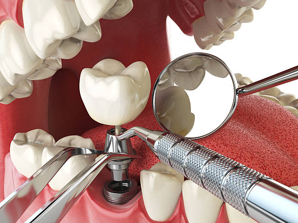 Best Emergency Tooth Extraction in La Plata, MO